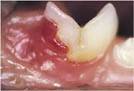 Lower tooth